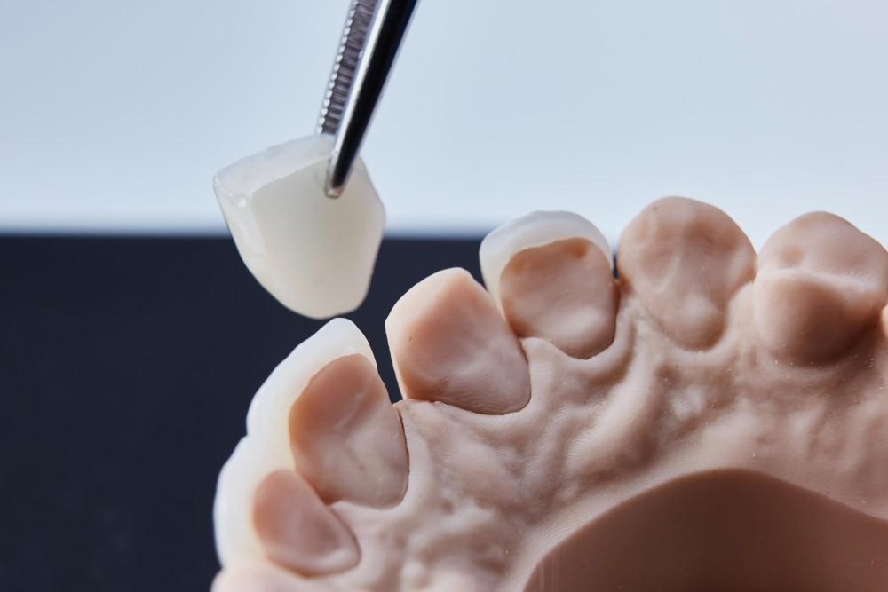 Forget the Temps. We Offer Same-Day Crowns With Our In-Office Milling Machine