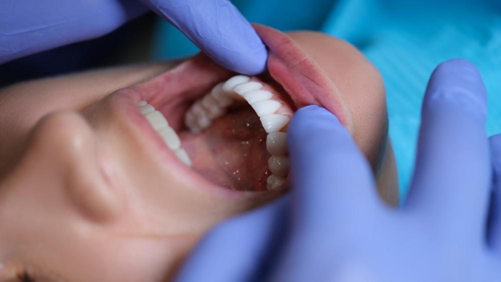 How Veneers Can Fix Chips, Gaps, and Discoloration for a Perfect Smile