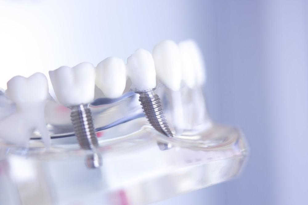 Are You a Candidate for Dental Implants?