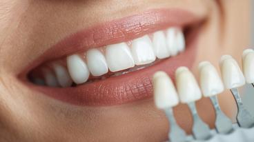 Why Same-Day Crowns Are the Best Option for Busy Professionals